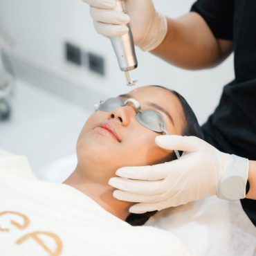 Face Laser Treatment 14